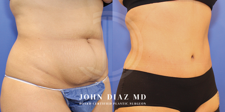Dr John Diaz tummy tuck
