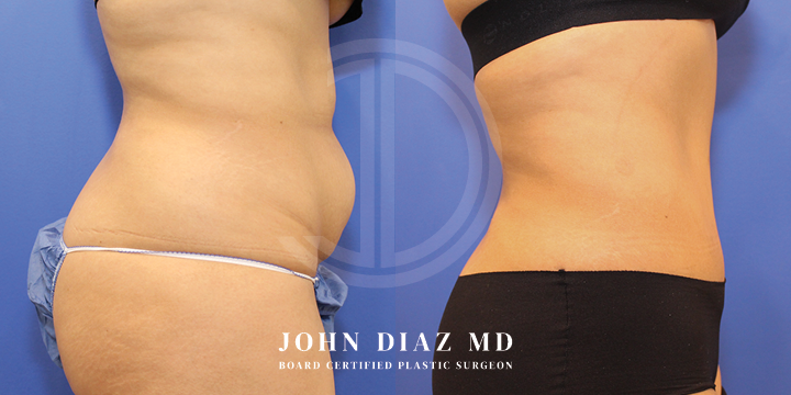 Dr John Diaz tummy tuck
