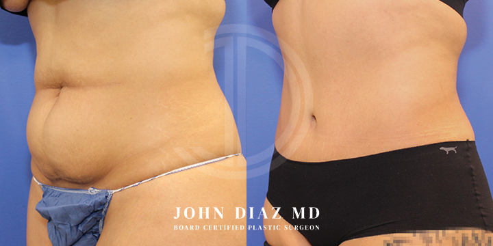Dr John Diaz tummy tuck