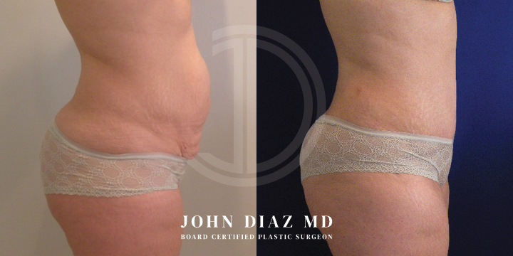Dr John Diaz tummy tuck