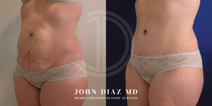 Dr John Diaz tummy tuck