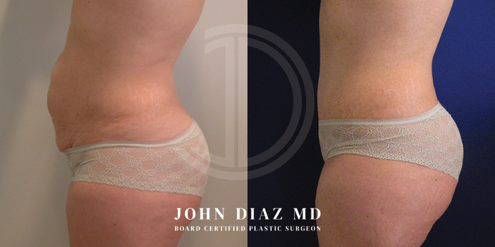 Dr John Diaz tummy tuck