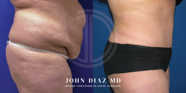 Dr John Diaz tummy tuck