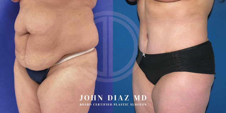 Dr John Diaz tummy tuck