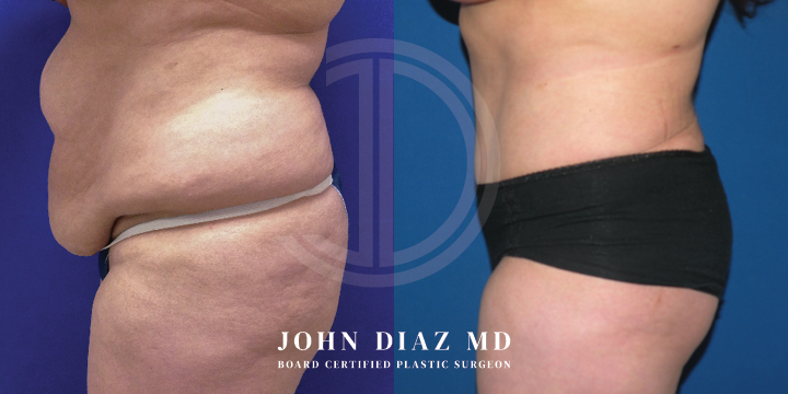 Dr John Diaz tummy tuck