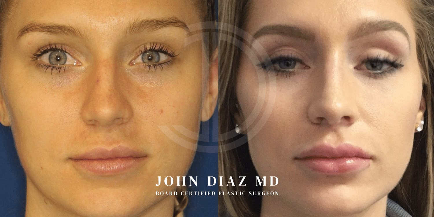 Dr John Diaz Rhinoplasty on female under 40
