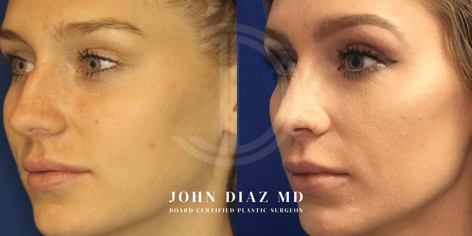 Dr John Diaz Rhinoplasty on female under 40