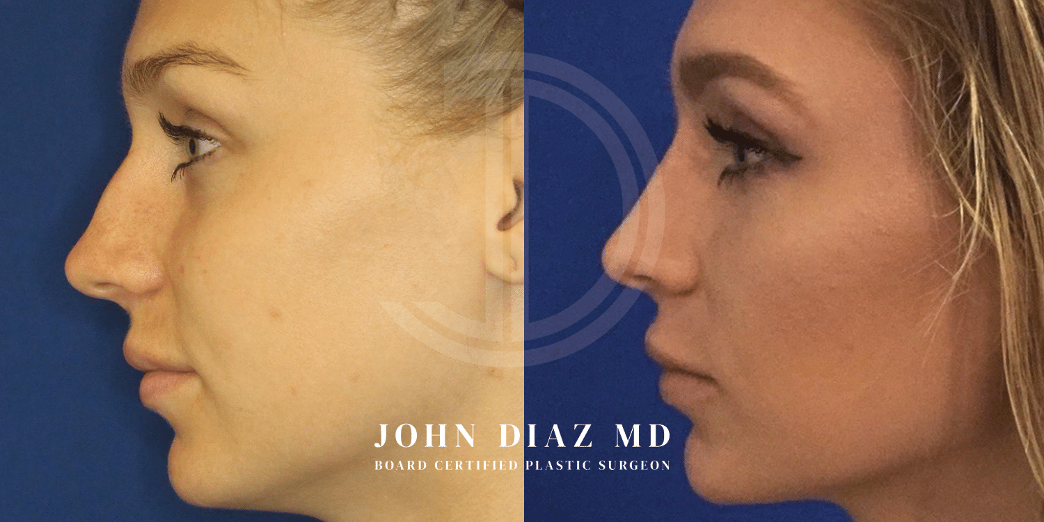 Dr John Diaz Rhinoplasty on female under 40