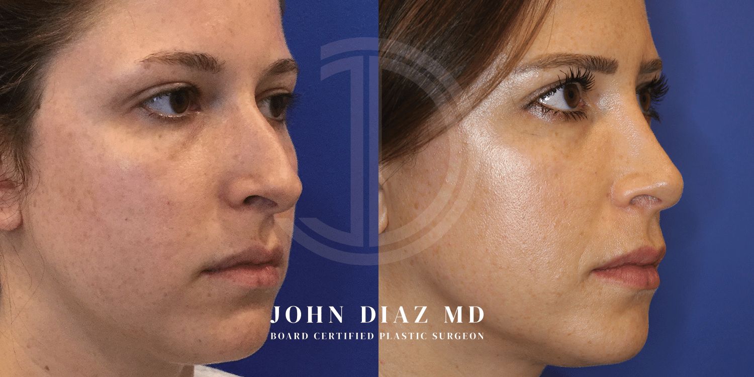 Dr John Diaz Rhinoplasty on female under 40
