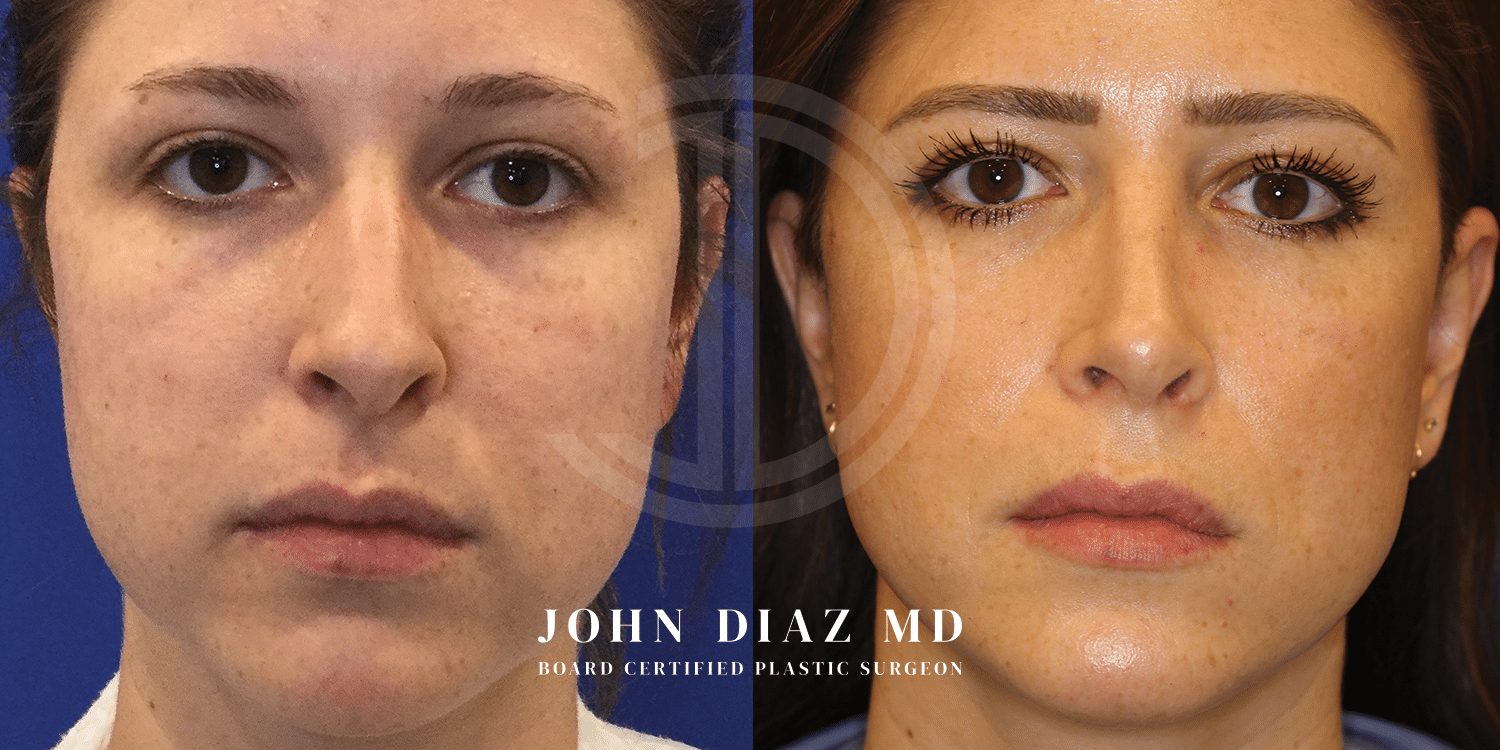 Dr John Diaz Rhinoplasty on female under 40
