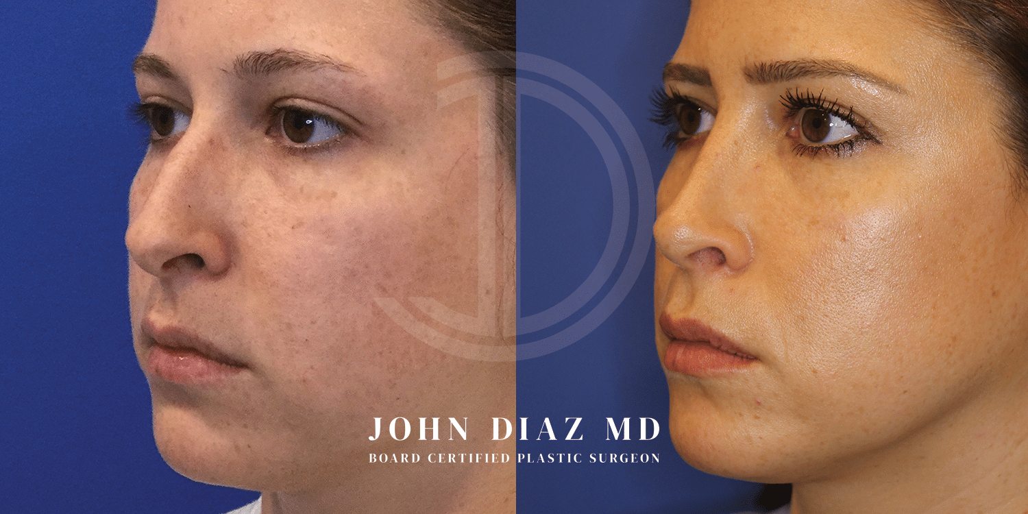 Dr John Diaz Rhinoplasty on female under 40