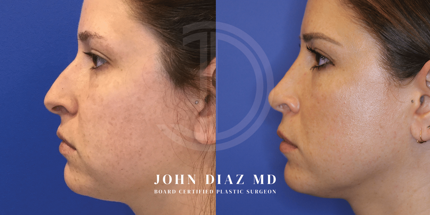 Dr John Diaz Rhinoplasty on female under 40