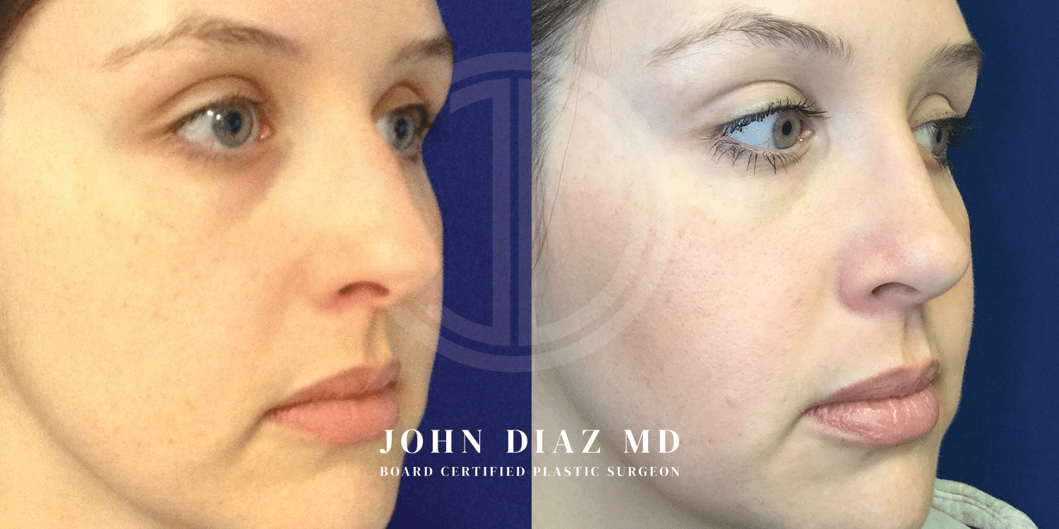 Dr John Diaz Rhinoplasty on female under 40