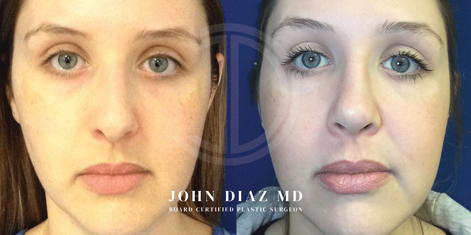 Dr John Diaz Rhinoplasty on female under 40