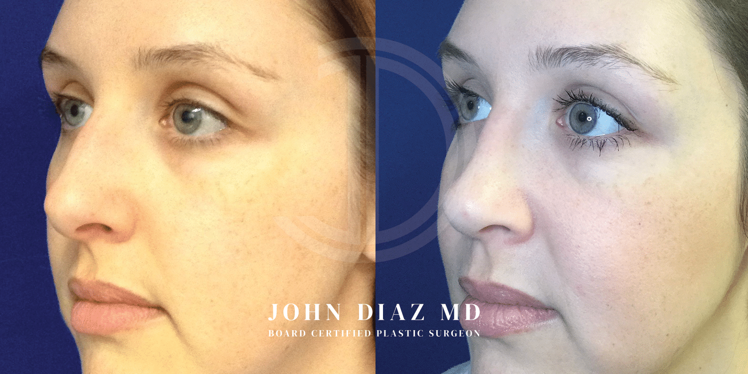 Dr John Diaz Rhinoplasty on female under 40