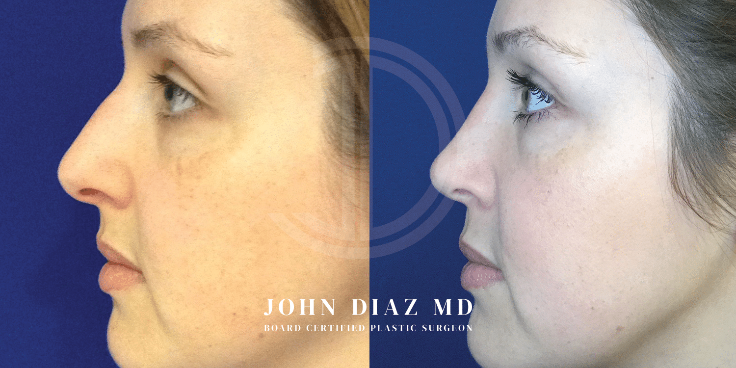 Dr John Diaz Rhinoplasty on female under 40