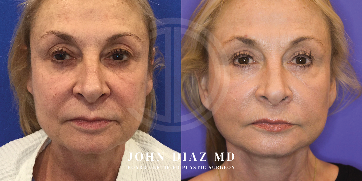 Dr John Diaz Facelift