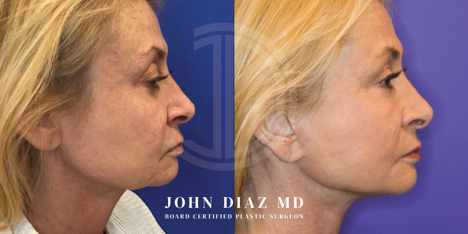 Dr John Diaz Facelift