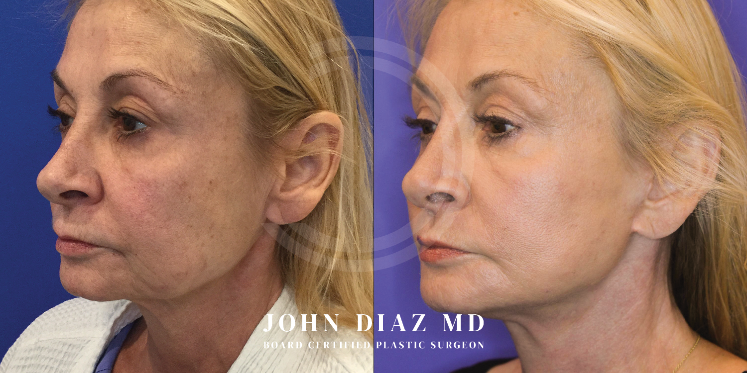 Dr John Diaz Facelift