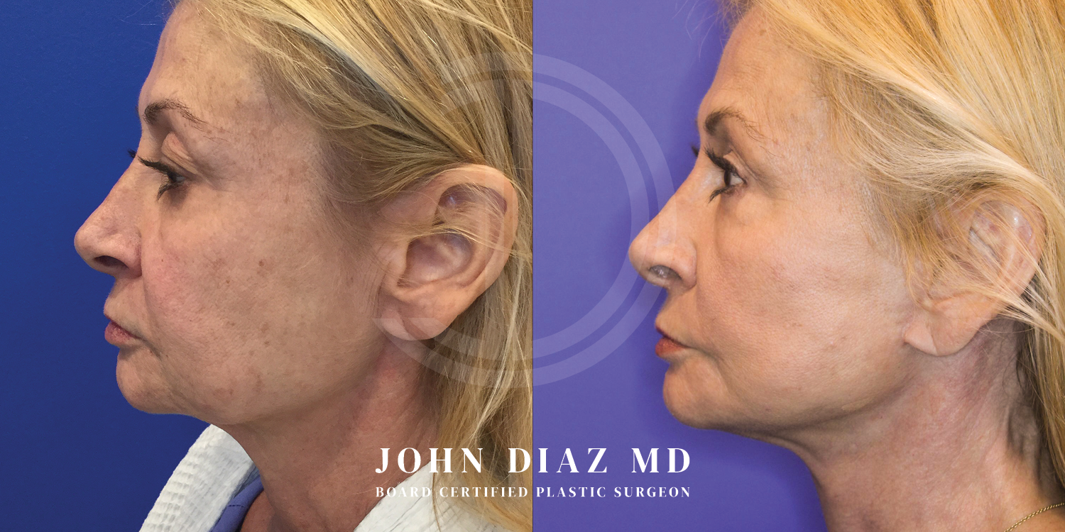 Dr John Diaz Facelift