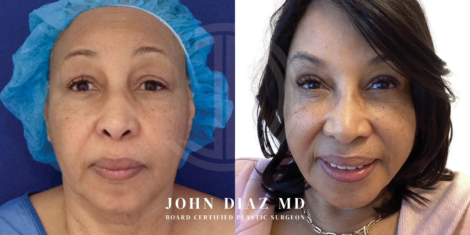 Dr John Diaz Facelift