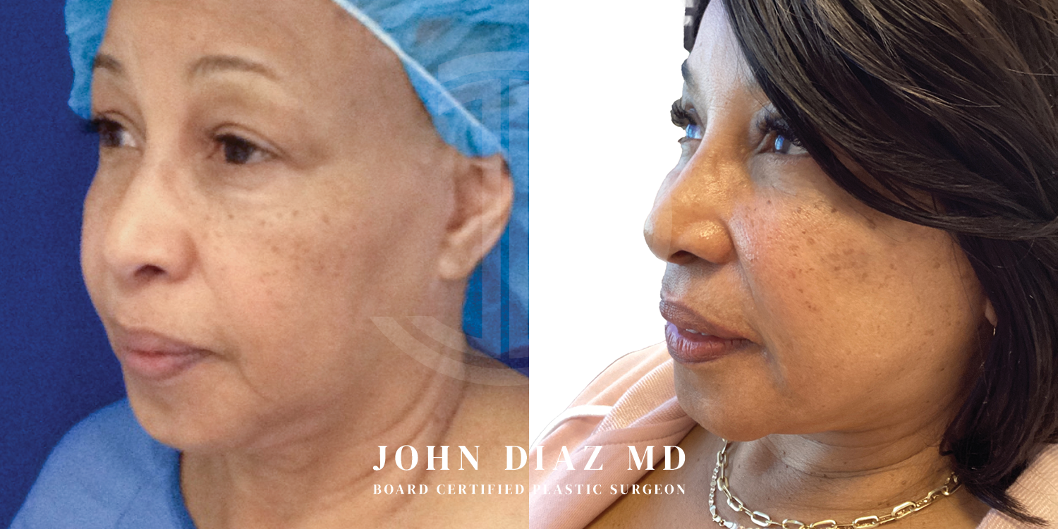 Dr John Diaz Facelift