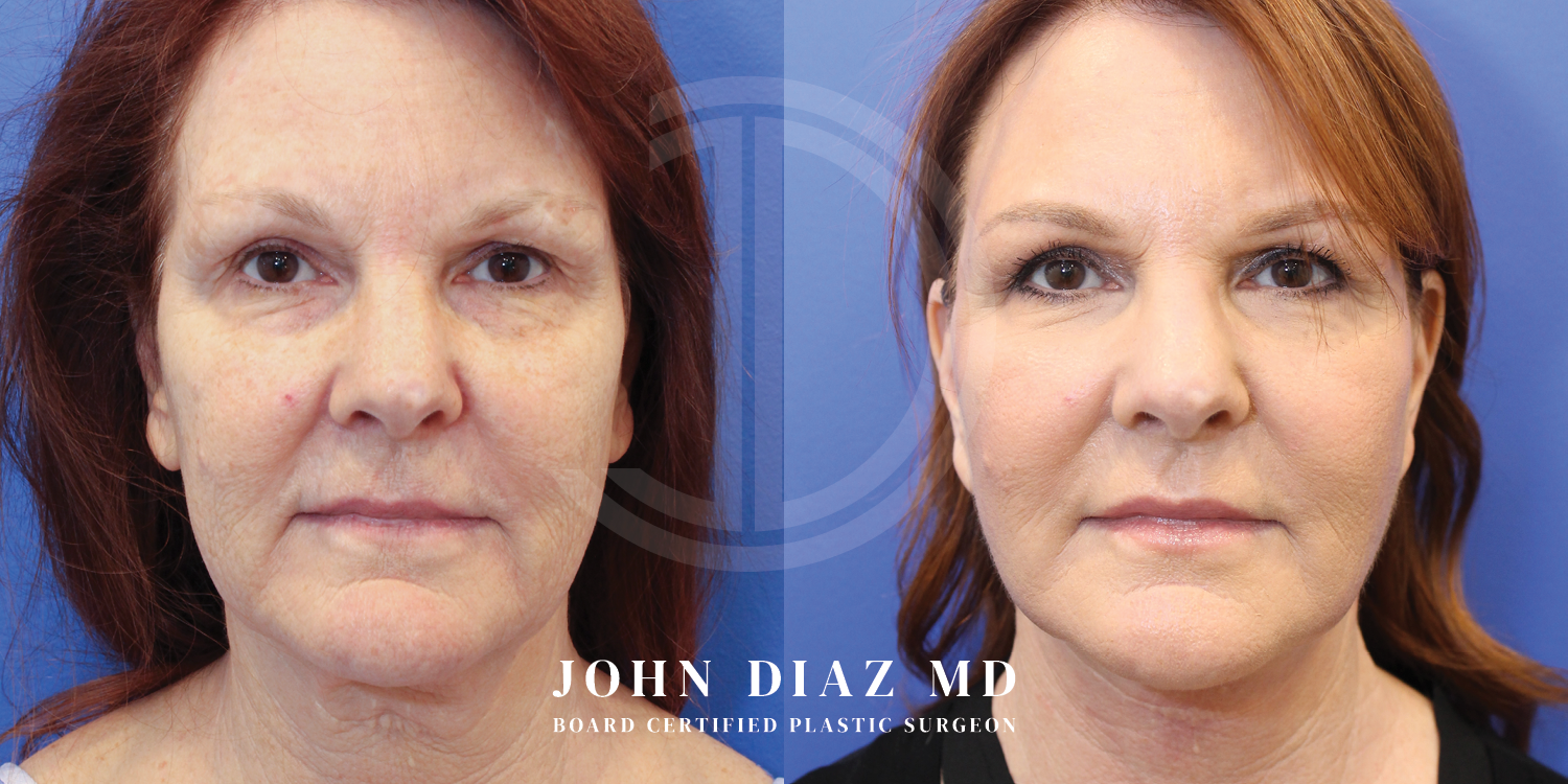 Dr John Diaz Facelift