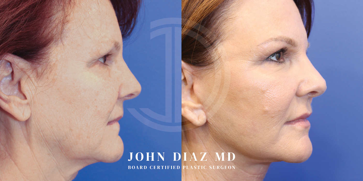 Dr John Diaz Facelift