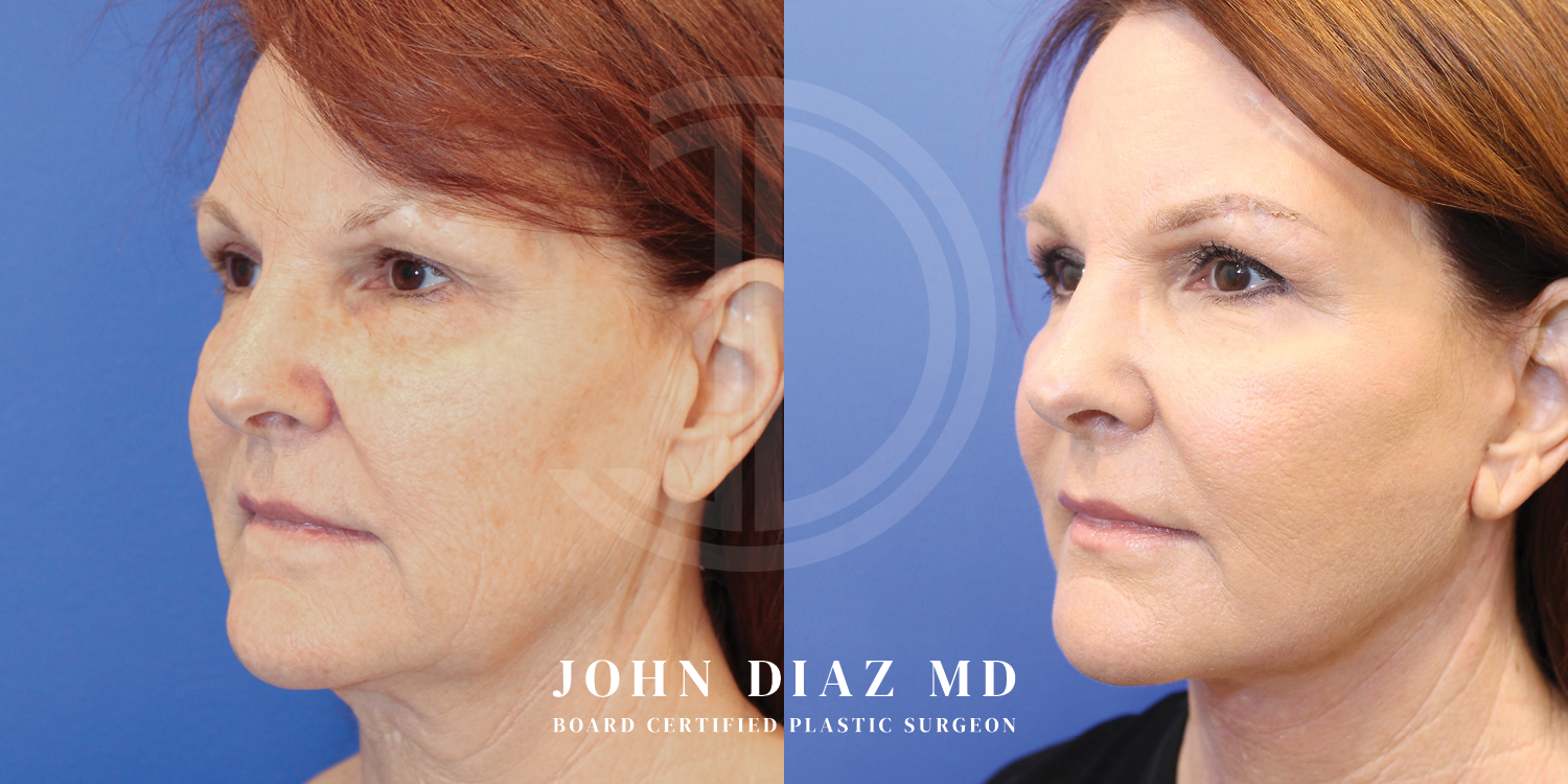 Dr John Diaz Facelift