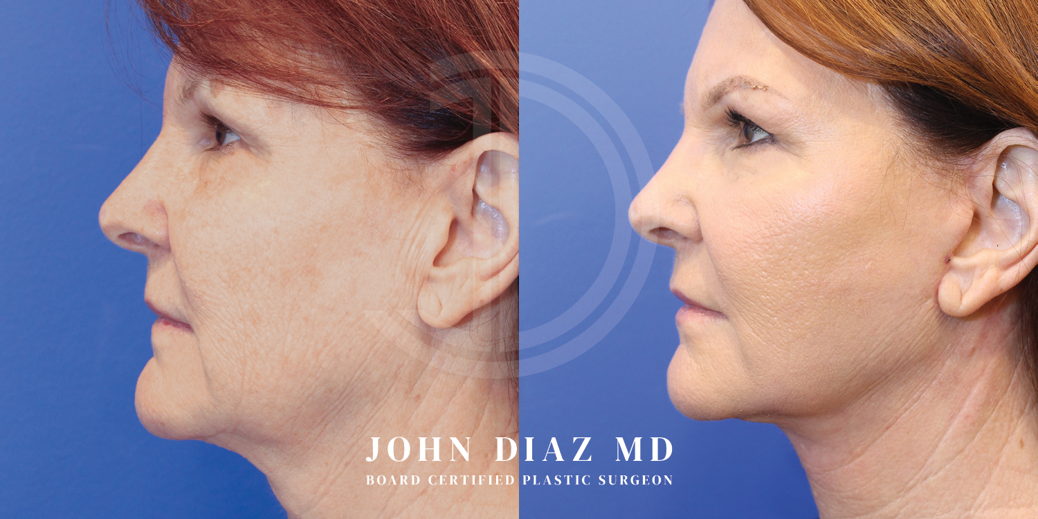 Dr John Diaz Facelift