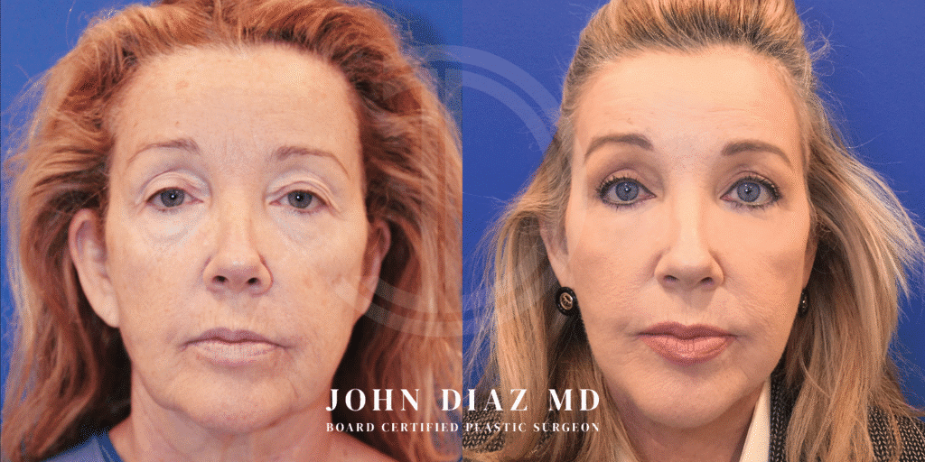 mini facelift and blepharoplasty in beverly hills