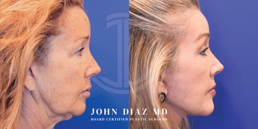 Dr John Diaz Facelift