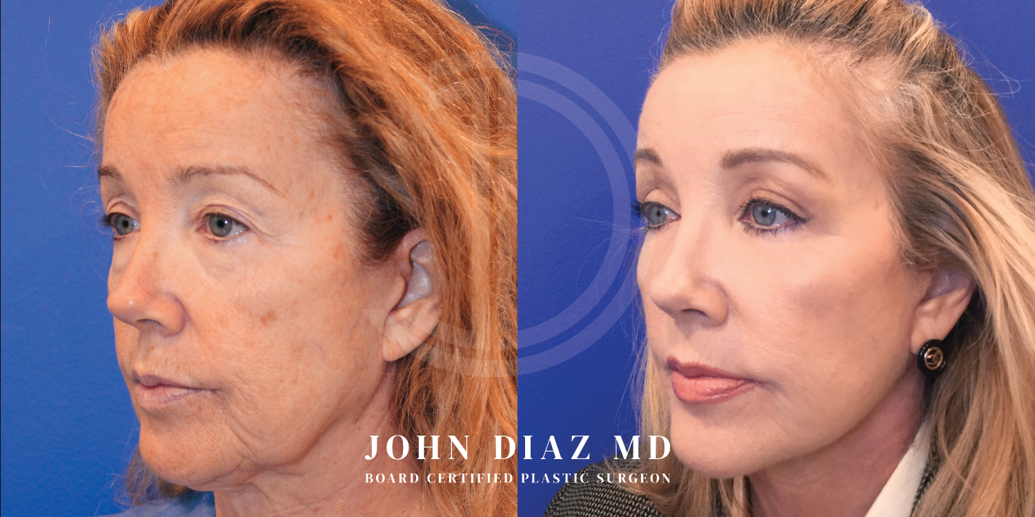 Dr John Diaz Facelift