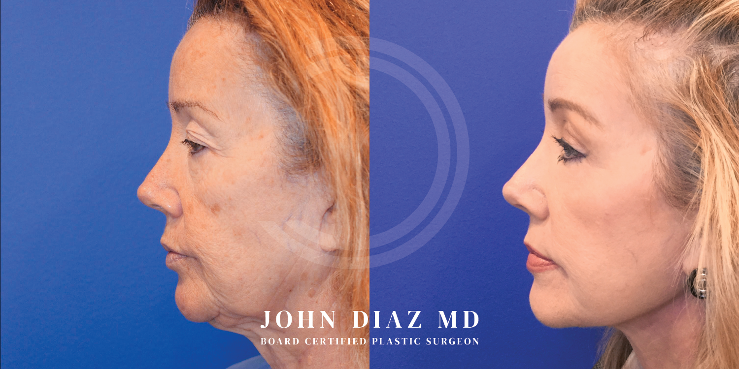 Dr John Diaz Facelift
