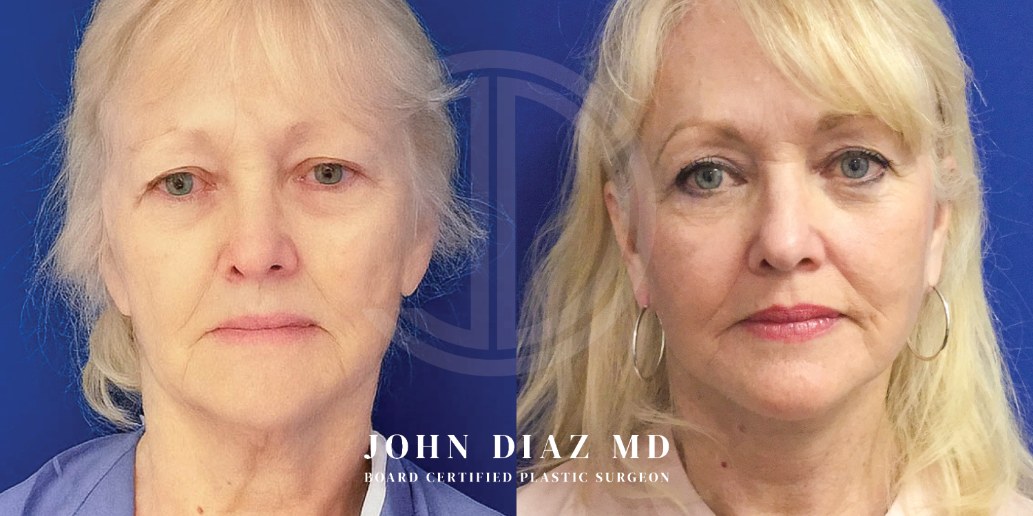 Dr John Diaz Facelift