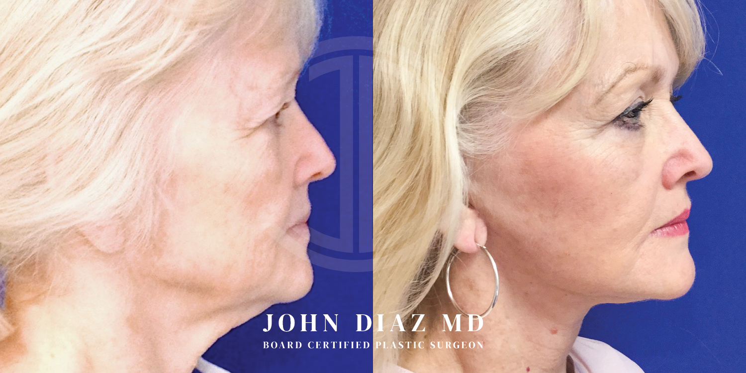 Dr John Diaz Facelift