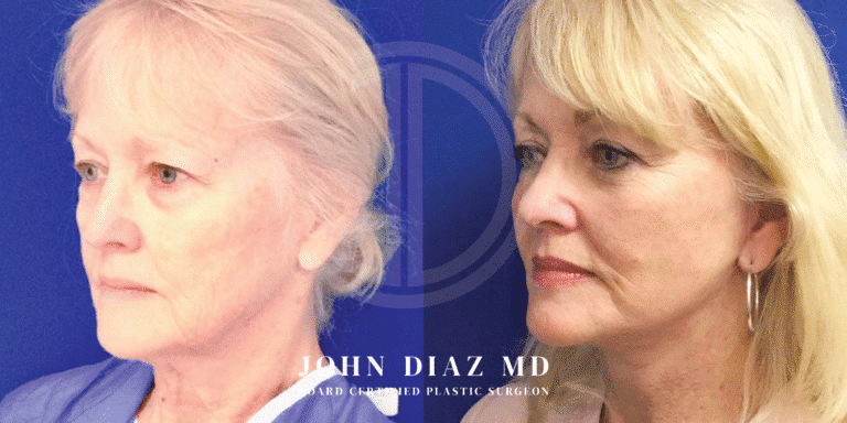 Dr John Diaz before and Facelift and neck lift in beverly hills
