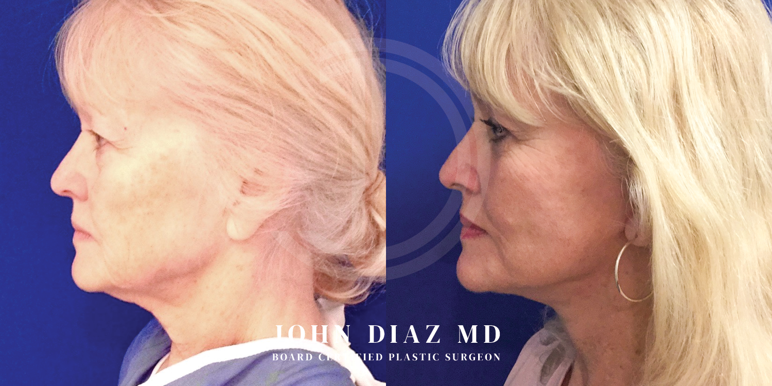 Dr John Diaz Facelift