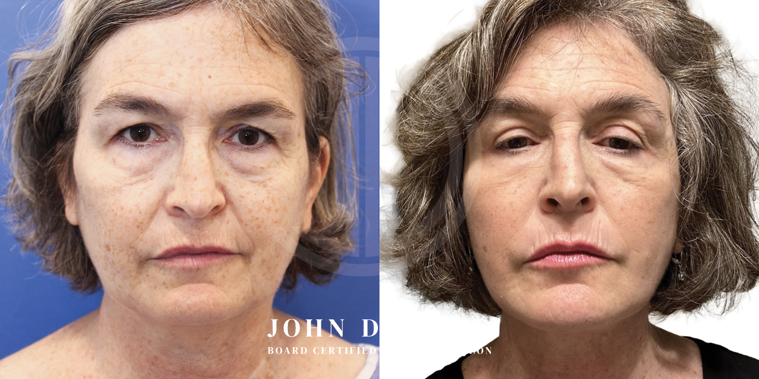 Dr John Diaz Facelift