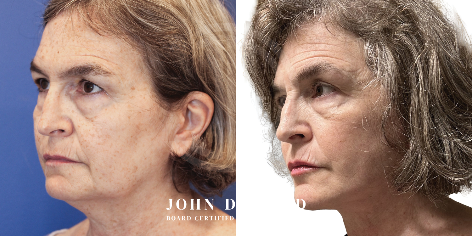 Dr John Diaz Facelift