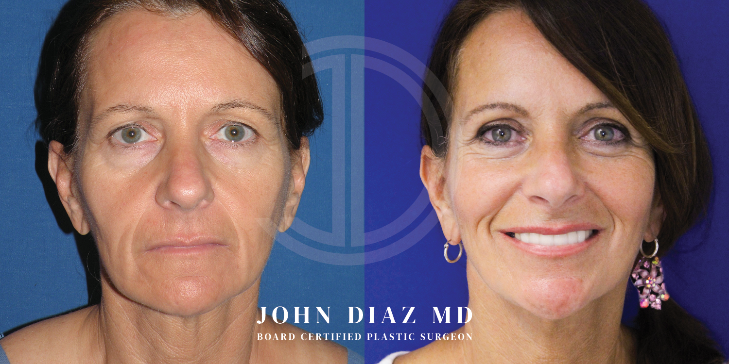 Dr John Diaz Facelift