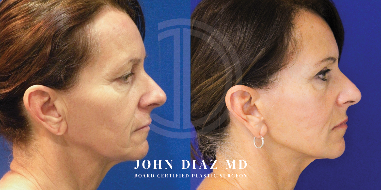 Dr John Diaz Facelift