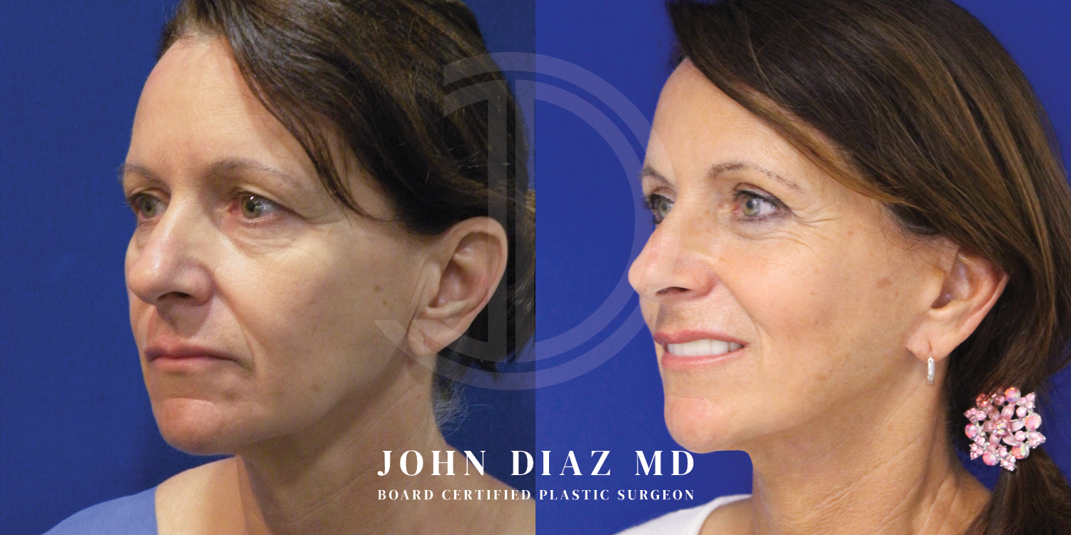 Dr John Diaz Facelift