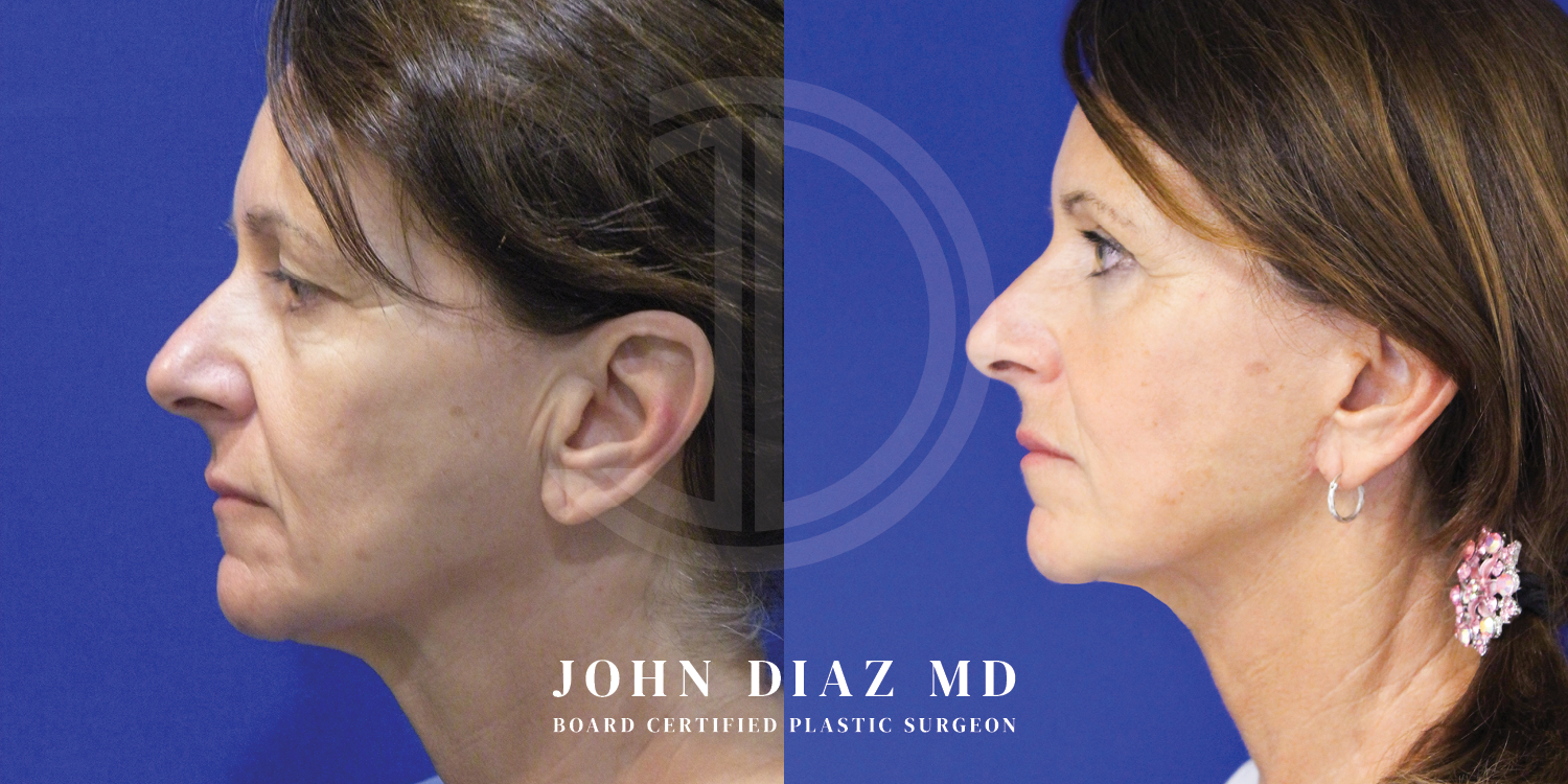 Dr John Diaz Facelift
