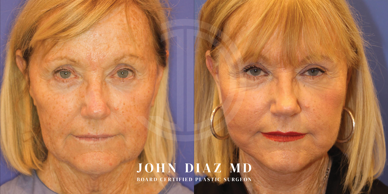 Dr John Diaz Facelift