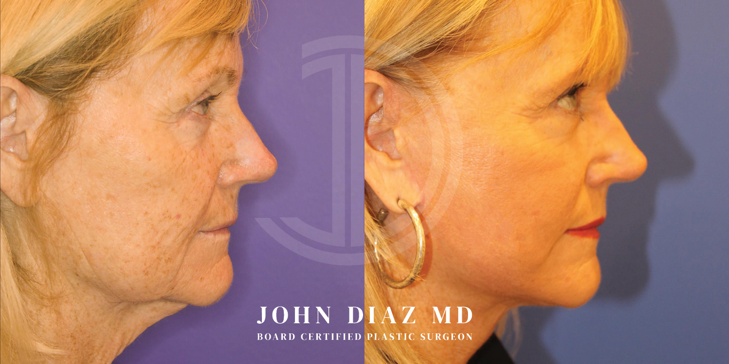 Dr John Diaz Facelift