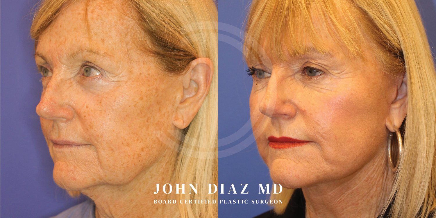 Dr John Diaz Facelift