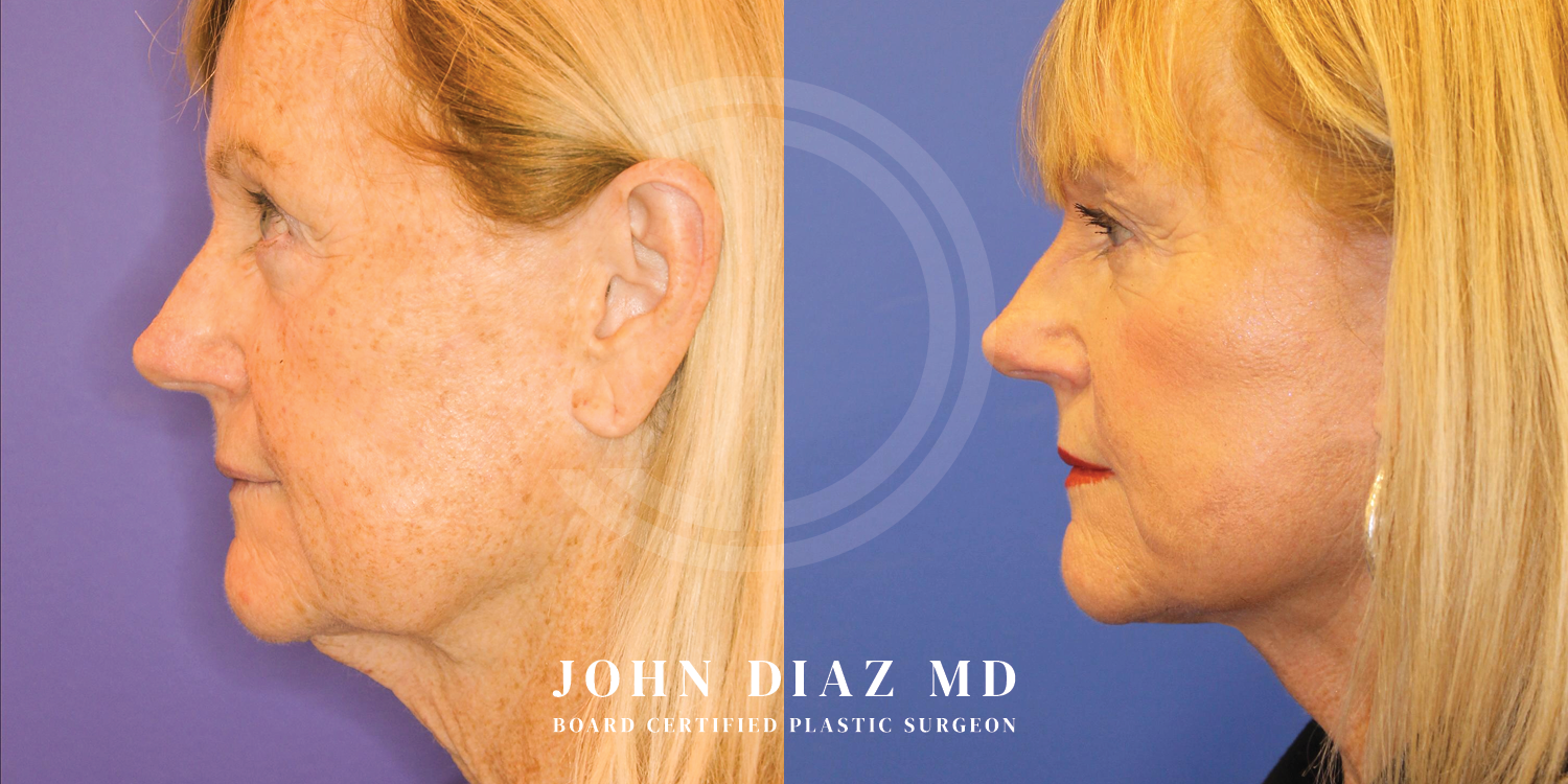Dr John Diaz Facelift