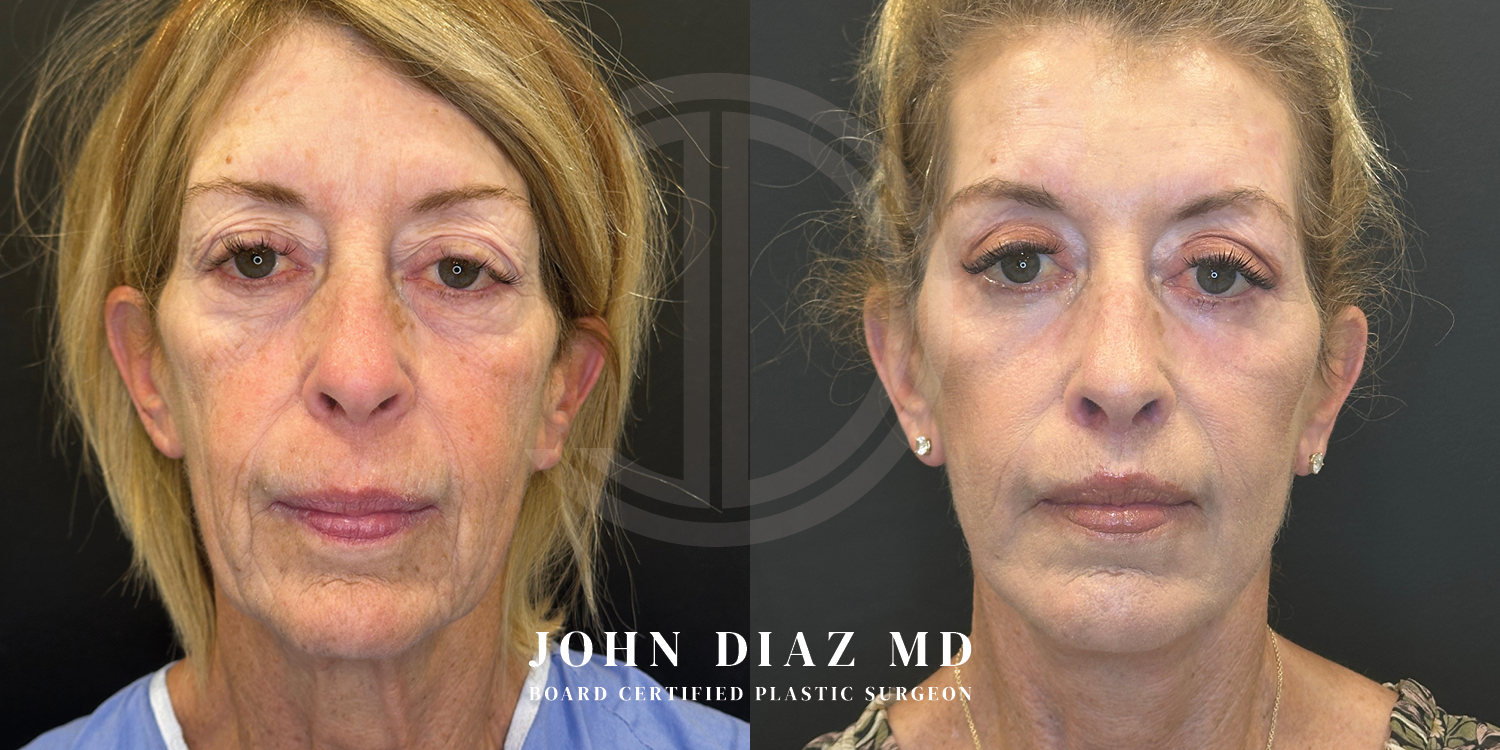 Dr John Diaz Facelift