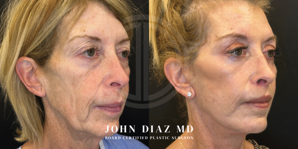 Dr John Diaz before and after Facelift